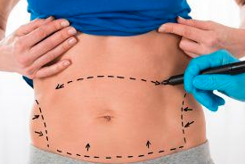 Medespoir abdominoplastie